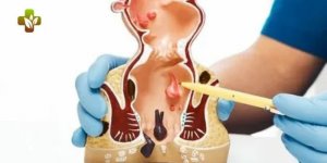 Right Clinic for Fissure Treatment in Delhi (1).jpg