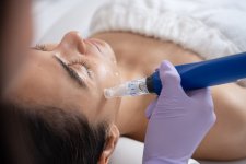 microneedling-treatment.jpg