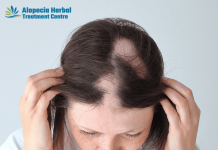 Alopecia Areata Treatment.png