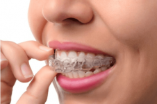 Invisalign Oxnard.png