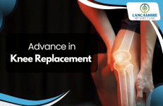 Advances-in-Knee-Replacement.png